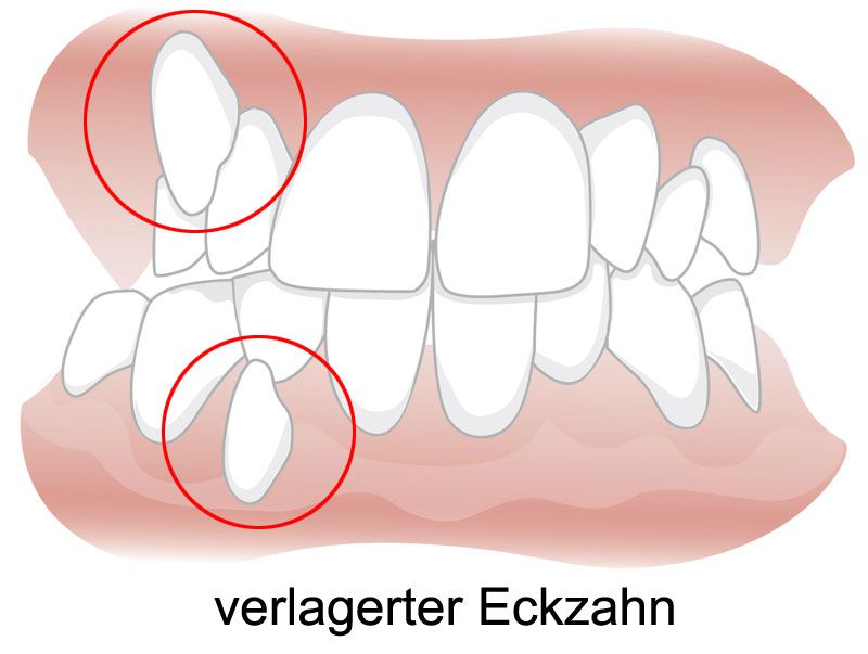 Verlagerte Retinierte Zahne Kieferorthopadie Bochum Wattenscheid