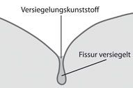 Fissurenversiegelung Fissurenversiegelung