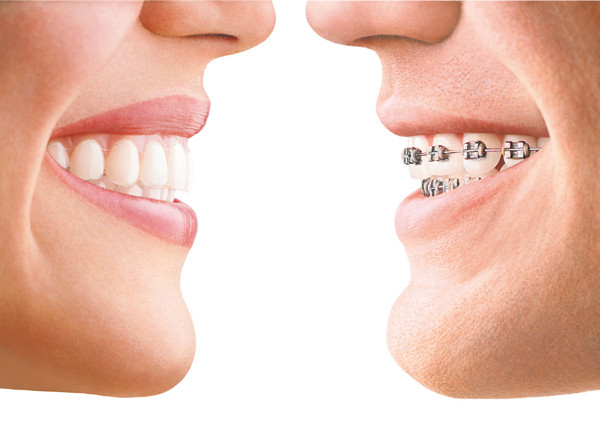Invisalign® Teen